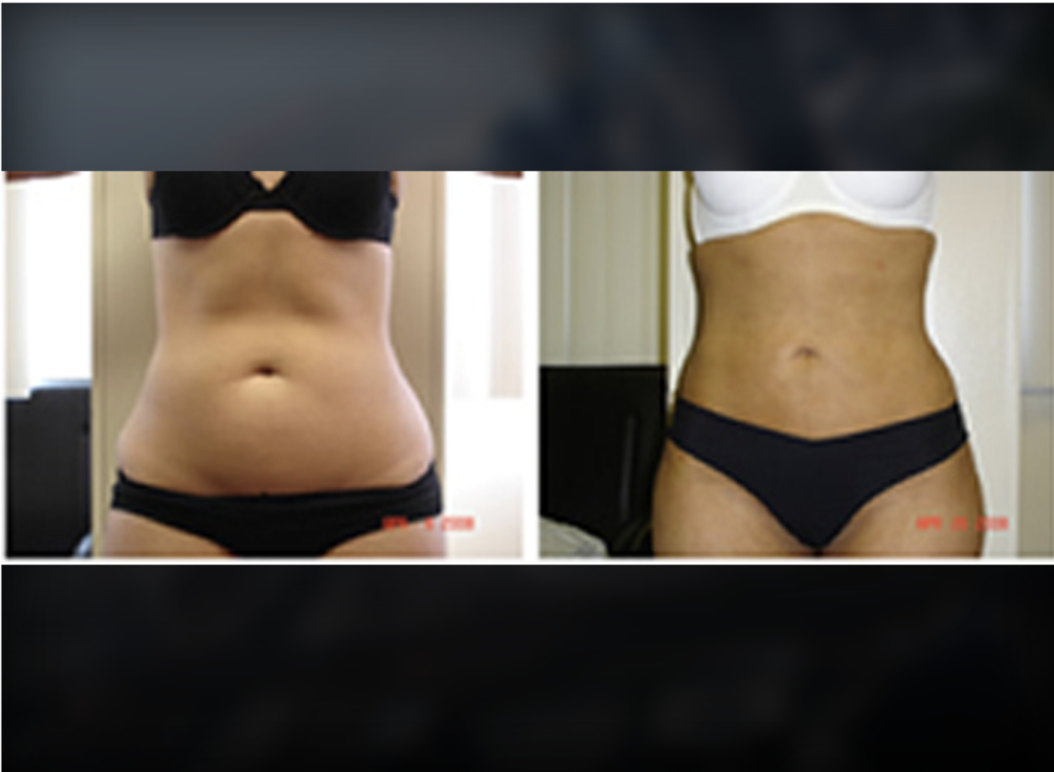 Facelift before and after