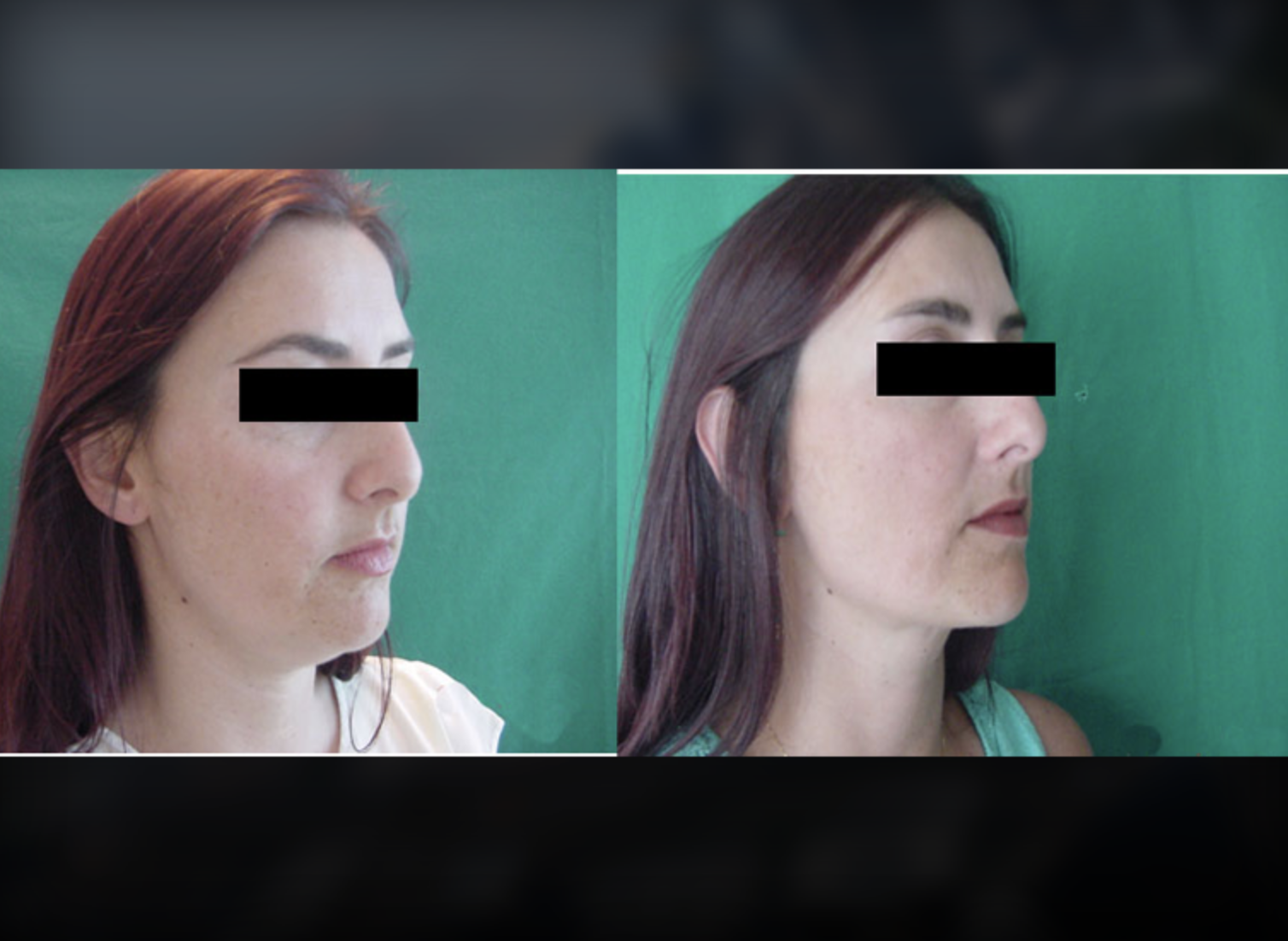 Tummy Tuck before and after