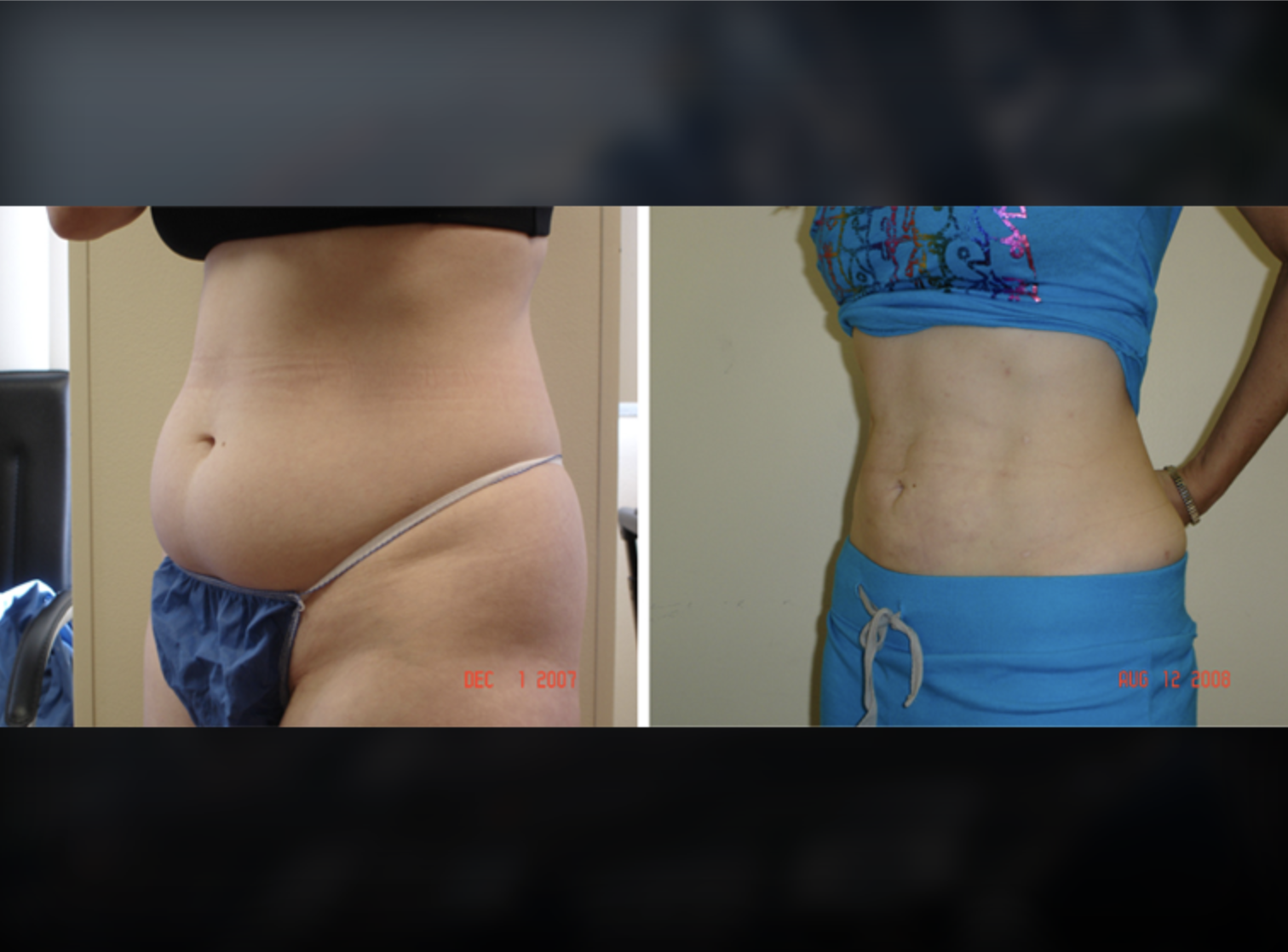 Eyelid Surgery before and after