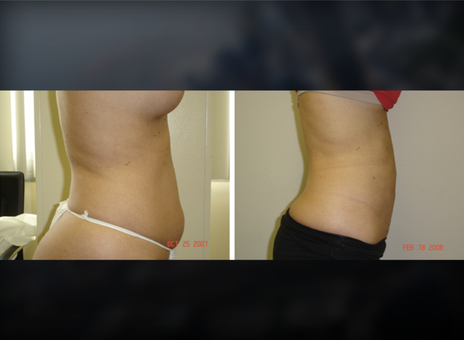 Breast Augmentation before and after