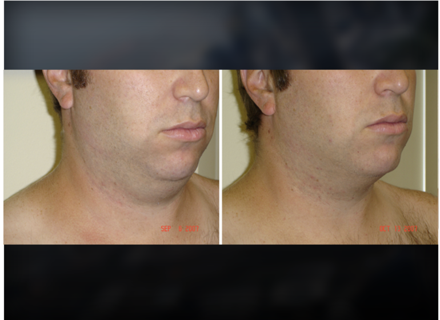 Liposuction before and after